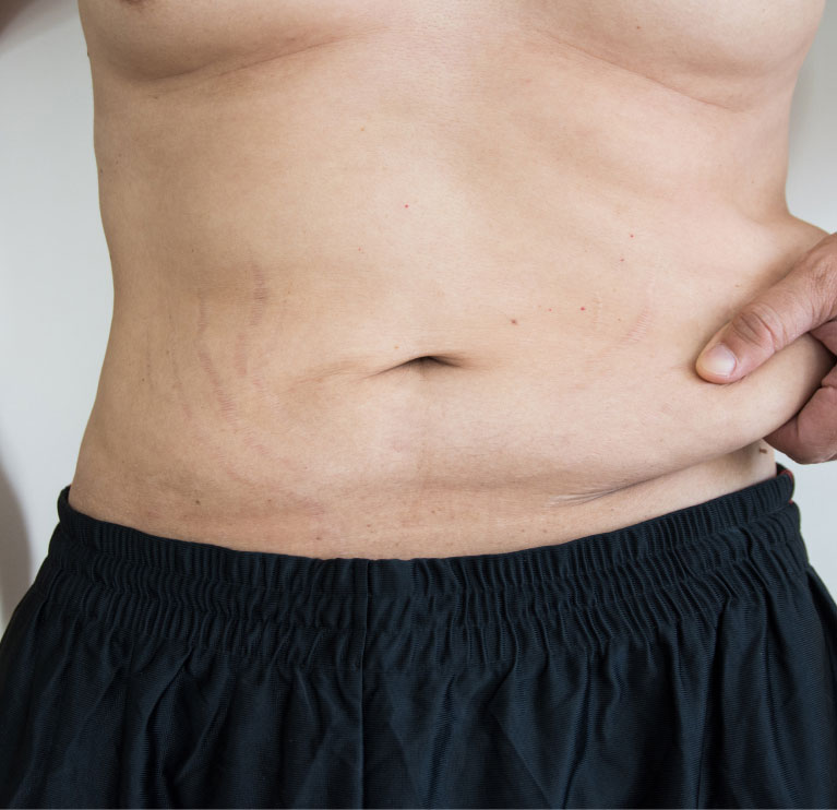 mishawaka man pinching fat before weight loss program