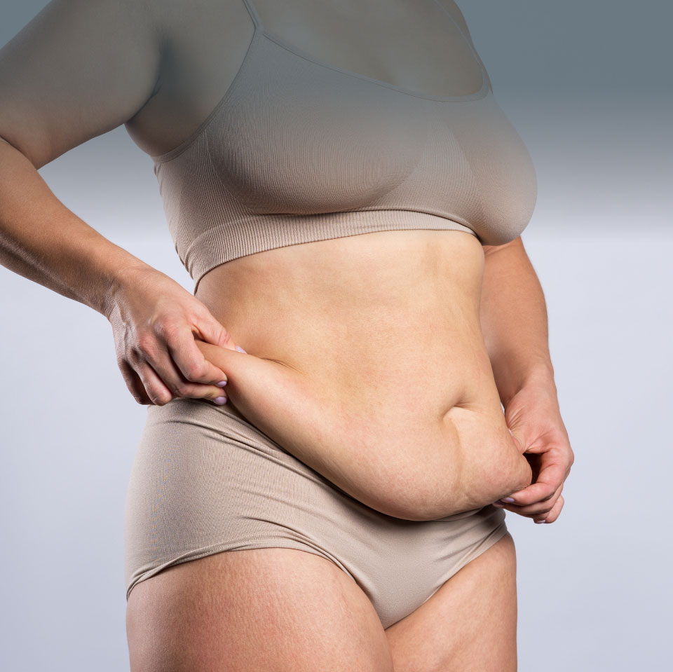 mishawaka woamn pinching loose skin before a tummy tuck